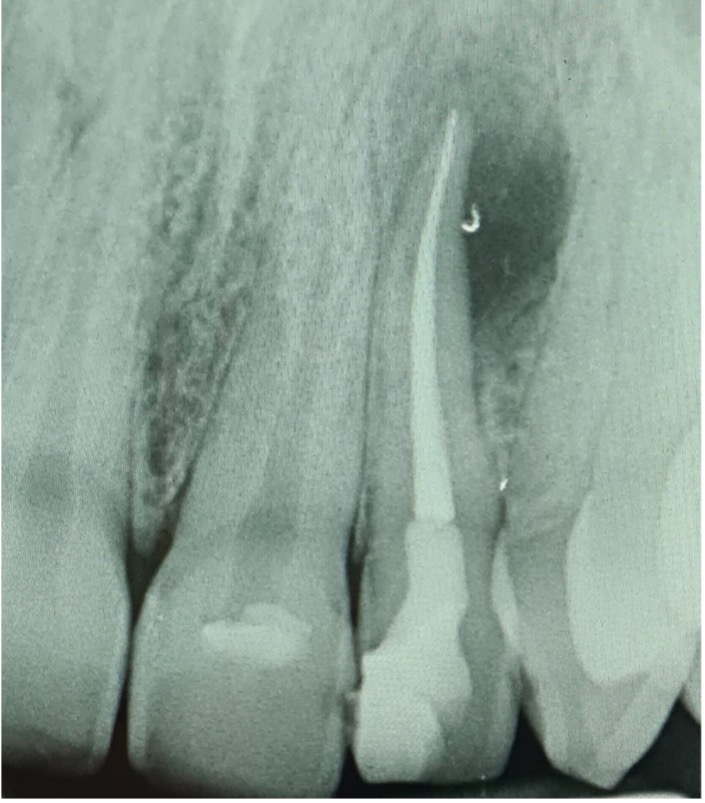 Root Canal Treatment