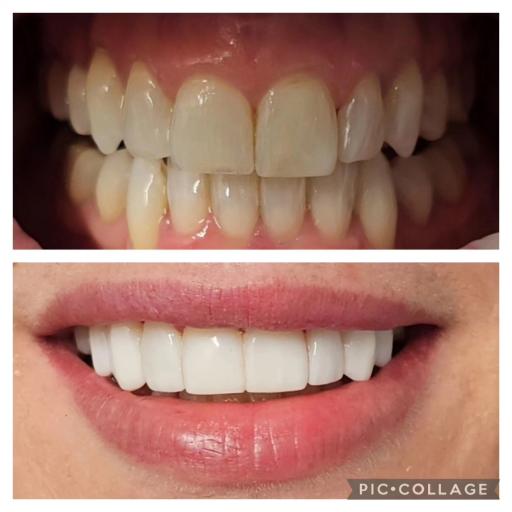 teeth whitening 