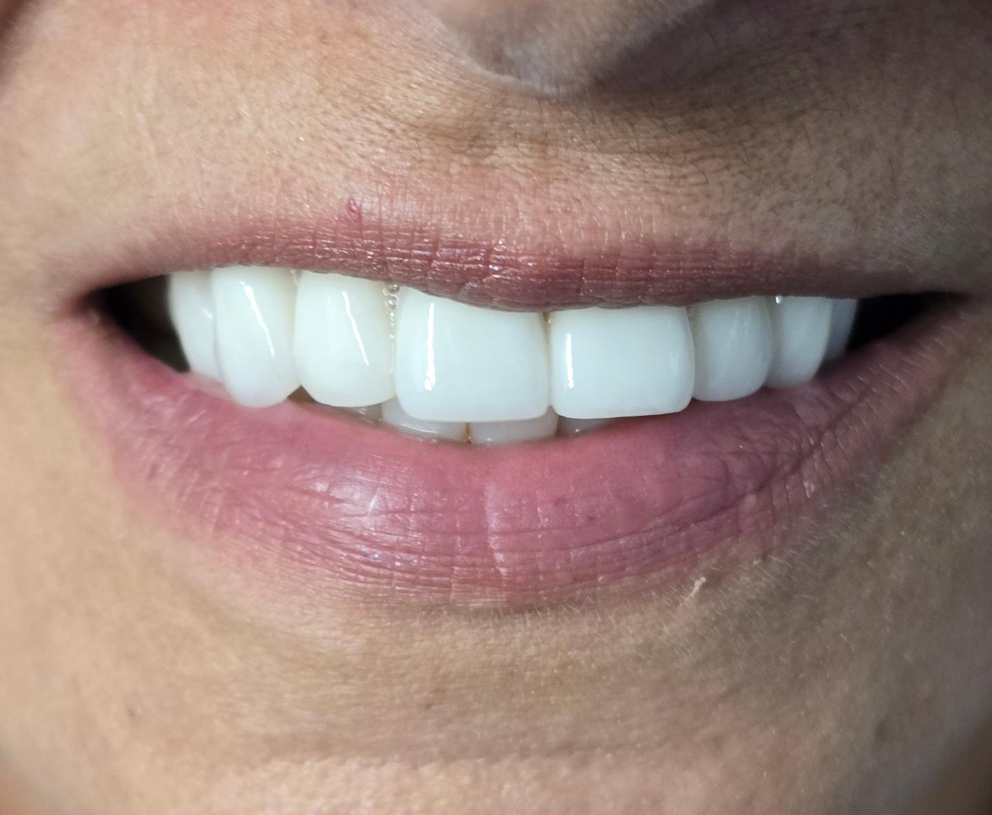 Minimally Invasive Cosmetic Dentistry