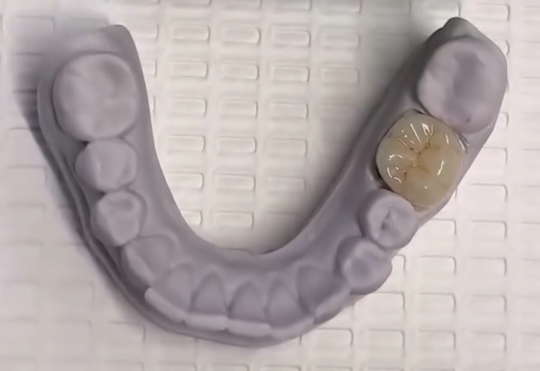 Intra Oral Scanning