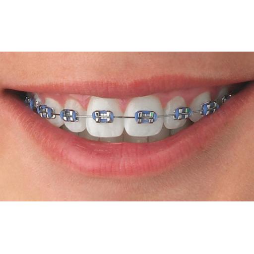 braces_image-2.jpg