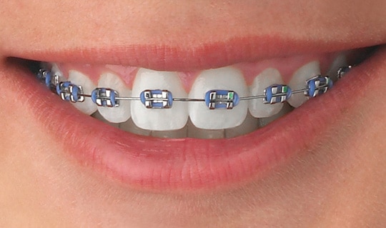 Braces Stafford: Transforming Smiles with Advanced Techniques