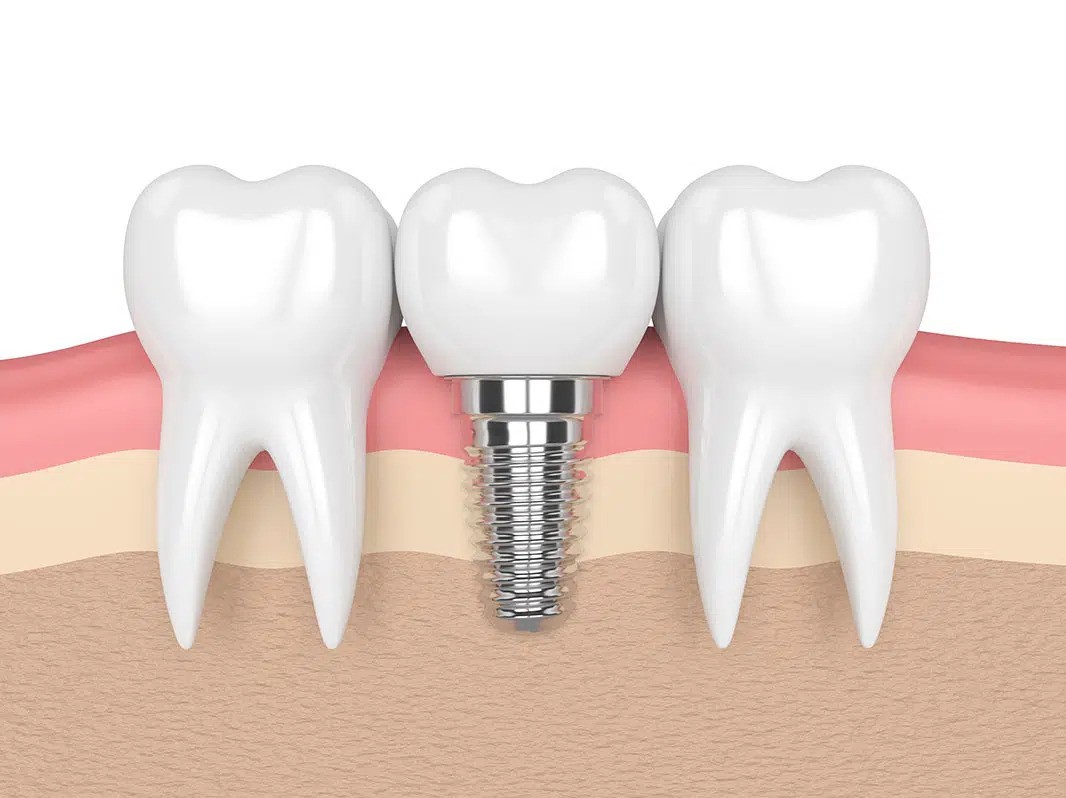 Common Myths About Dental Implants Debunked
