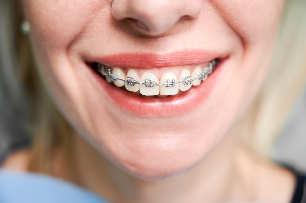 How Do Braces Actually Work? A Simple Guide for Patients
