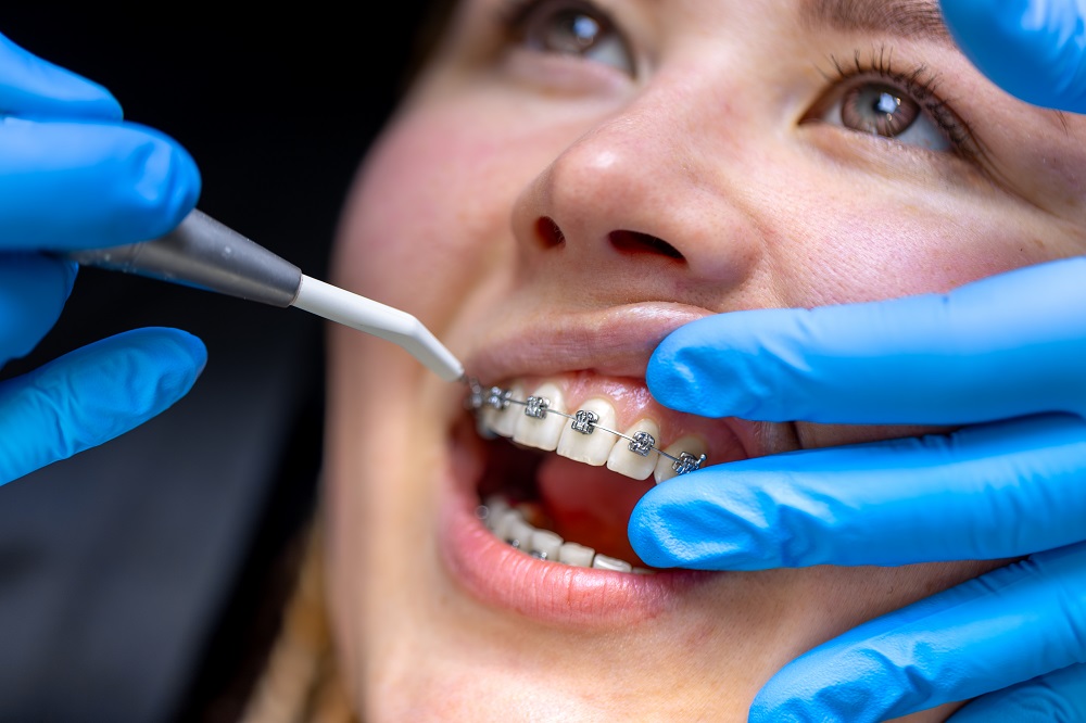 What Happens If You Miss an Orthodontic Appointment?